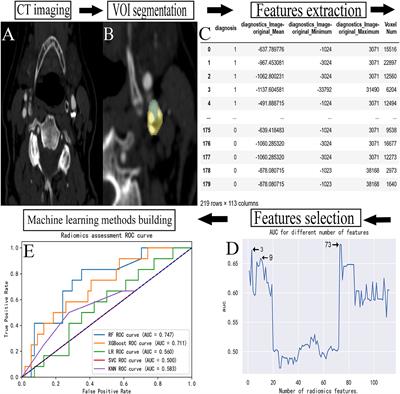 Predicting transient ischemic attack risk in patients with mild carotid stenosis using machine learning and CT radiomics